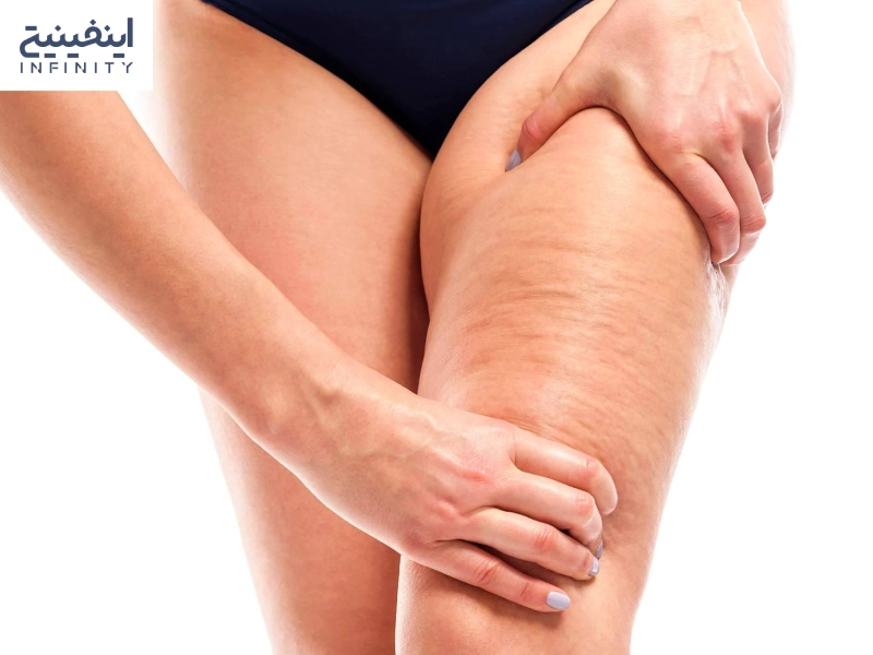 علت به وجود آمدن سلولیت چیست؟