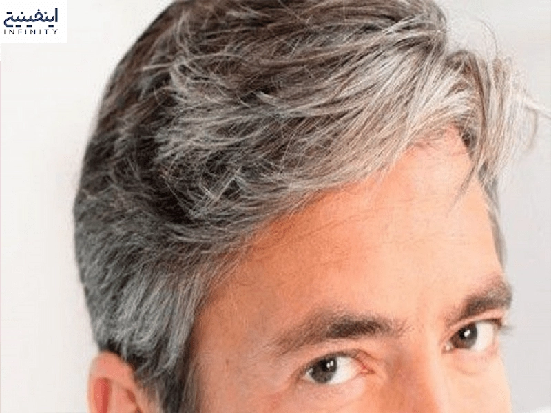 علت سفید شدن مو