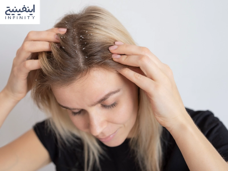 علل ایجاد شوره سر و بهترین راه ها برای درمان آن
