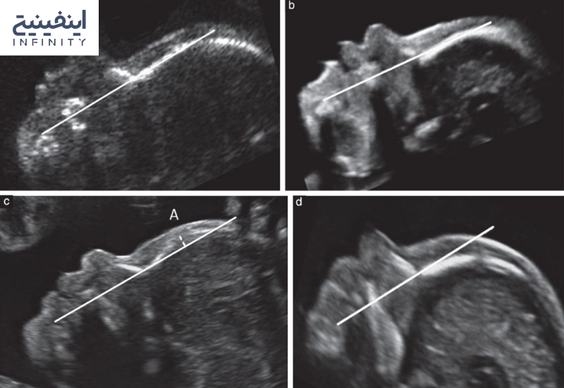  عکس جنین مبتلا به سندرم ‌داون
