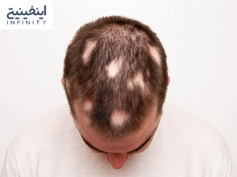 ریزش مو سکهای چیست؟